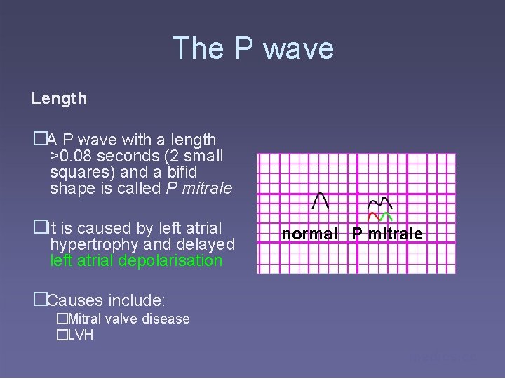 The P wave Length �A P wave with a length >0. 08 seconds (2