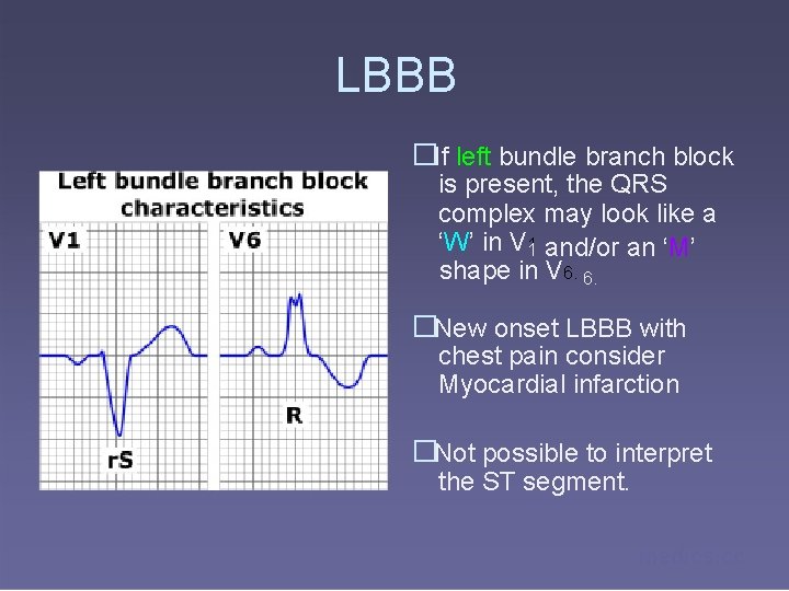 LBBB �If left bundle branch block is present, the QRS complex may look like