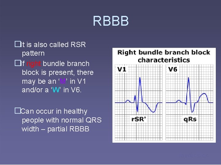 RBBB �It is also called RSR pattern �If right bundle branch block is present,