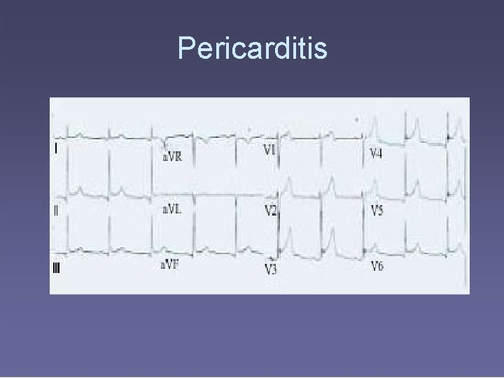 Pericarditis medics. cc 