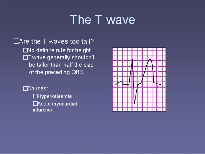 The T wave �Are the T waves too tall? �No definite rule for height