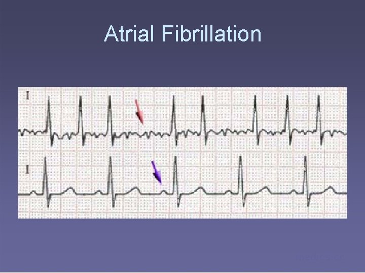 Atrial Fibrillation medics. cc 