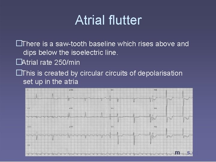 Atrial flutter �There is a saw-tooth baseline which rises above and dips below the