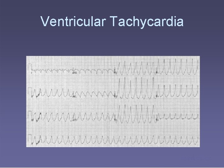 Ventricular Tachycardia medics. cc 
