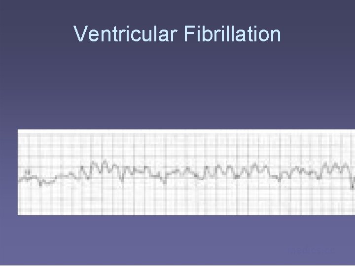 Ventricular Fibrillation medics. cc 