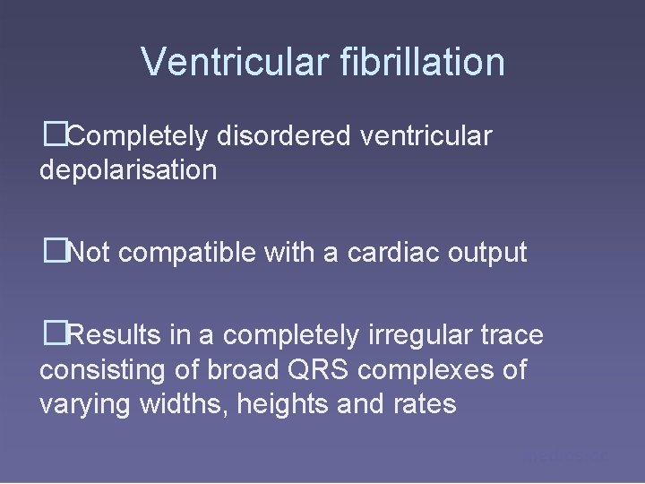 Ventricular fibrillation �Completely disordered ventricular depolarisation �Not compatible with a cardiac output �Results in