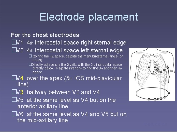 Electrode placement For the chest electrodes �V 1 4 th intercostal space right sternal