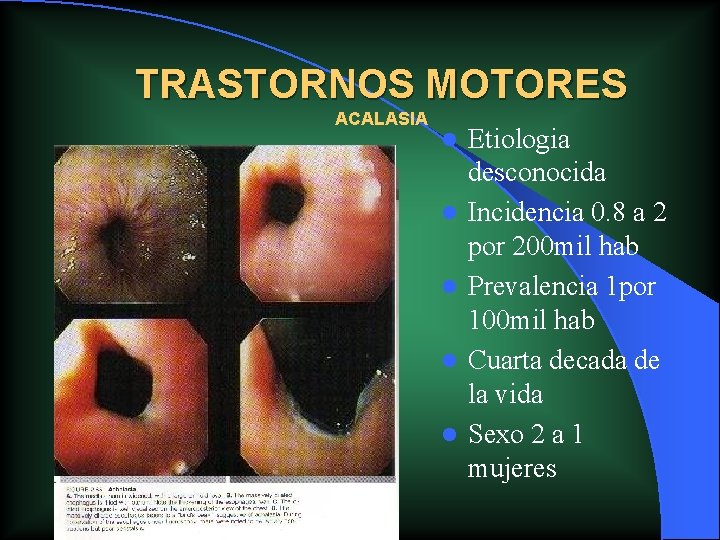 TRASTORNOS MOTORES ACALASIA l l l Etiologia desconocida Incidencia 0. 8 a 2 por TRASTORNOS MOTORES ACALASIA l l l Etiologia desconocida Incidencia 0. 8 a 2 por
