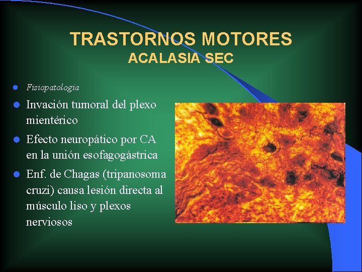 TRASTORNOS MOTORES ACALASIA SEC l Fisiopatologia l Invación tumoral del plexo mientérico l Efecto TRASTORNOS MOTORES ACALASIA SEC l Fisiopatologia l Invación tumoral del plexo mientérico l Efecto