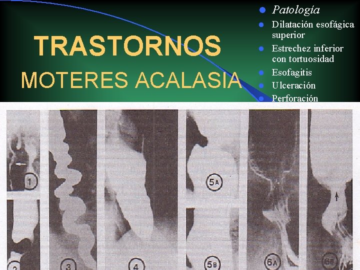 TRASTORNOS MOTERES ACALASIA l Patología l Dilatación esofágica superior Estrechez inferior con tortuosidad Esofagitis TRASTORNOS MOTERES ACALASIA l Patología l Dilatación esofágica superior Estrechez inferior con tortuosidad Esofagitis