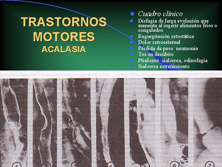 TRASTORNOS MOTORES ACALASIA l l l l Cuadro clínico Disfagia de larga evolución que TRASTORNOS MOTORES ACALASIA l l l l Cuadro clínico Disfagia de larga evolución que