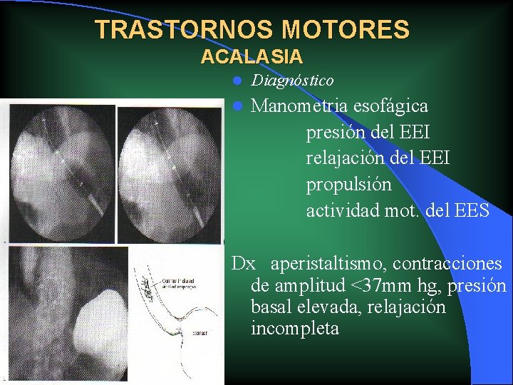 TRASTORNOS MOTORES ACALASIA l Diagnóstico l Manometria esofágica presión del EEI relajación del EEI TRASTORNOS MOTORES ACALASIA l Diagnóstico l Manometria esofágica presión del EEI relajación del EEI