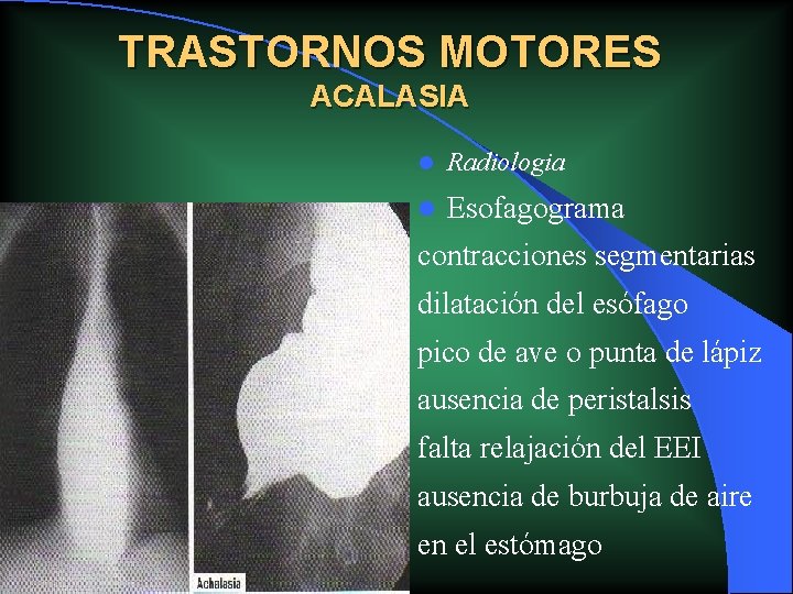 TRASTORNOS MOTORES ACALASIA l Radiologia l Esofagograma contracciones segmentarias dilatación del esófago pico de TRASTORNOS MOTORES ACALASIA l Radiologia l Esofagograma contracciones segmentarias dilatación del esófago pico de