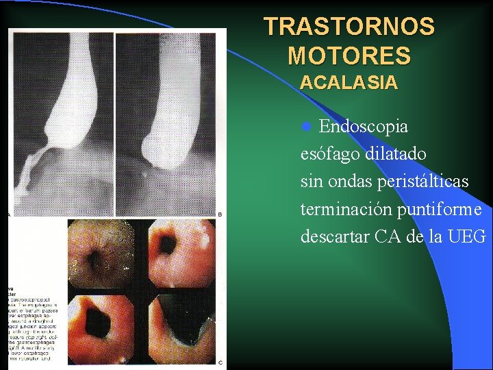 TRASTORNOS MOTORES ACALASIA Endoscopia esófago dilatado sin ondas peristálticas terminación puntiforme descartar CA de TRASTORNOS MOTORES ACALASIA Endoscopia esófago dilatado sin ondas peristálticas terminación puntiforme descartar CA de