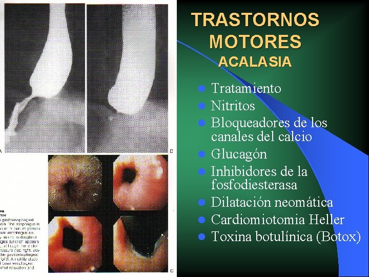 TRASTORNOS MOTORES ACALASIA l l l l Tratamiento Nitritos Bloqueadores de los canales del TRASTORNOS MOTORES ACALASIA l l l l Tratamiento Nitritos Bloqueadores de los canales del