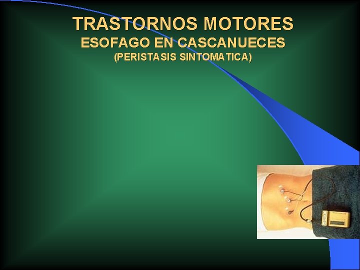 TRASTORNOS MOTORES ESOFAGO EN CASCANUECES (PERISTASIS SINTOMATICA) TRASTORNOS MOTORES ESOFAGO EN CASCANUECES (PERISTASIS SINTOMATICA)
