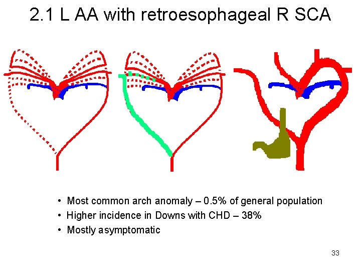 2. 1 L AA with retroesophageal R SCA • Most common arch anomaly –