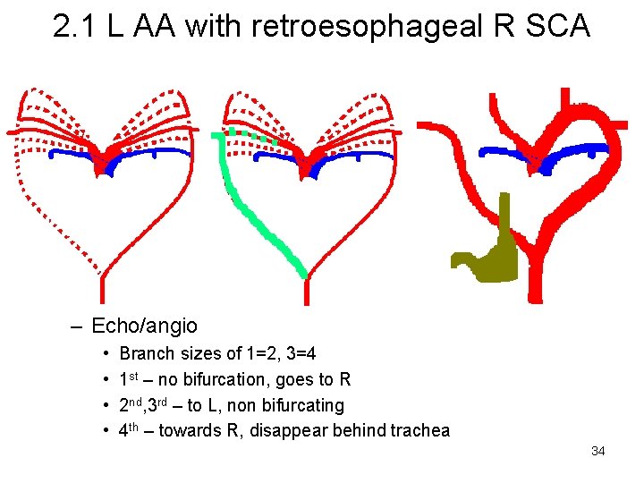 2. 1 L AA with retroesophageal R SCA • Diagnosis – Echo/angio • •