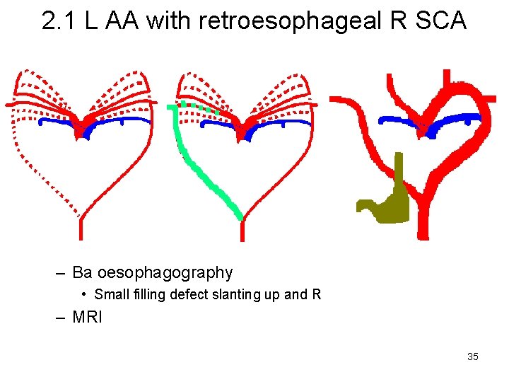 2. 1 L AA with retroesophageal R SCA – Ba oesophagography • Small filling