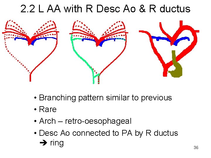 2. 2 L AA with R Desc Ao & R ductus • Branching pattern