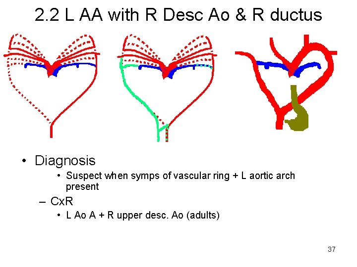 2. 2 L AA with R Desc Ao & R ductus • Diagnosis •