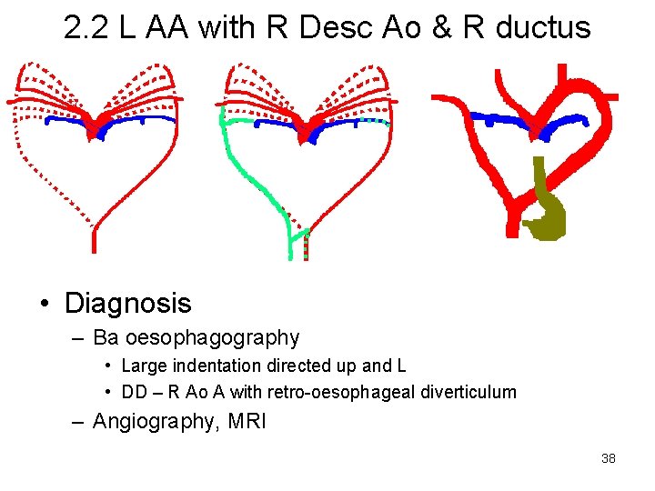 2. 2 L AA with R Desc Ao & R ductus • Diagnosis –