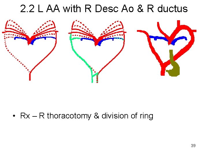 2. 2 L AA with R Desc Ao & R ductus • Rx –