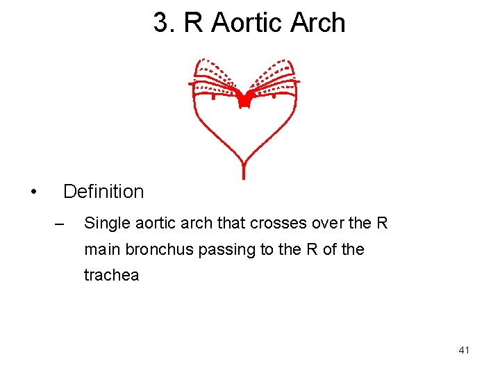 3. R Aortic Arch • Definition – Single aortic arch that crosses over the
