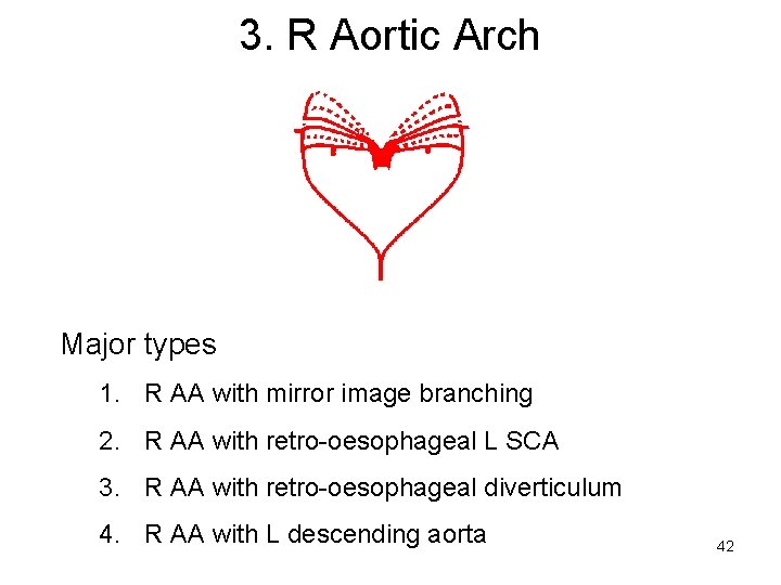 3. R Aortic Arch Major types 1. R AA with mirror image branching 2.