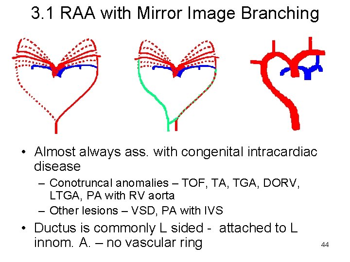 3. 1 RAA with Mirror Image Branching • Almost always ass. with congenital intracardiac