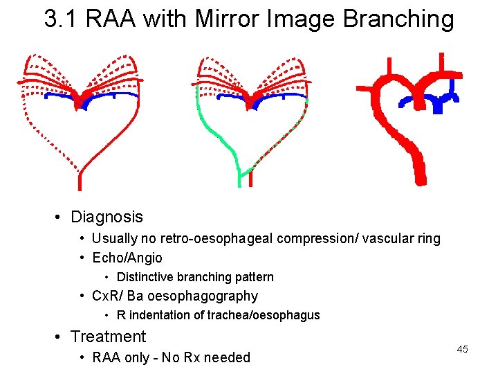 3. 1 RAA with Mirror Image Branching • Diagnosis • Usually no retro-oesophageal compression/