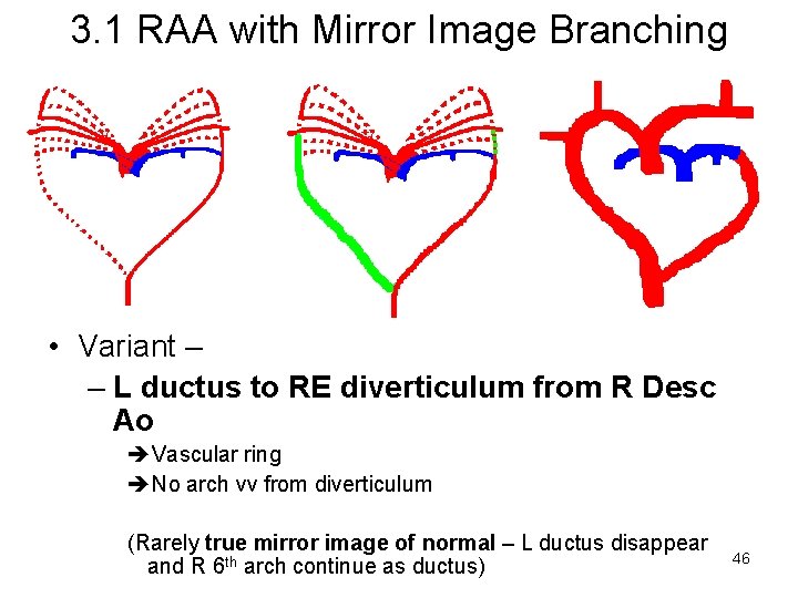 3. 1 RAA with Mirror Image Branching • Variant – – L ductus to