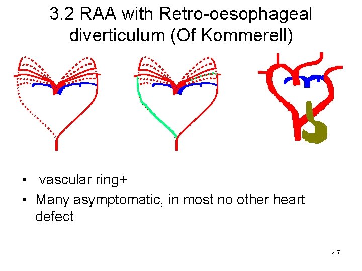 3. 2 RAA with Retro-oesophageal diverticulum (Of Kommerell) • vascular ring+ • Many asymptomatic,