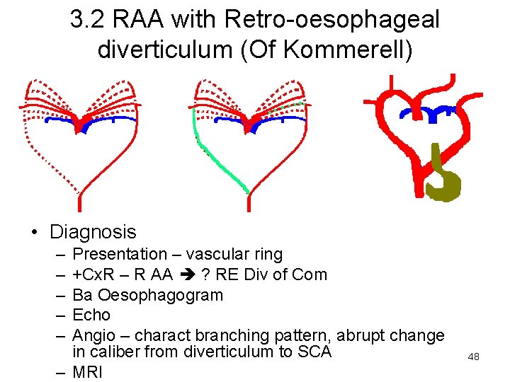 3. 2 RAA with Retro-oesophageal diverticulum (Of Kommerell) • Diagnosis – – – Presentation