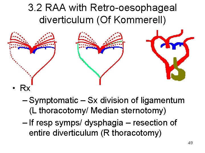 3. 2 RAA with Retro-oesophageal diverticulum (Of Kommerell) • Rx – Symptomatic – Sx