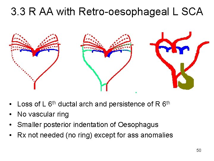 3. 3 R AA with Retro-oesophageal L SCA • • Loss of L 6