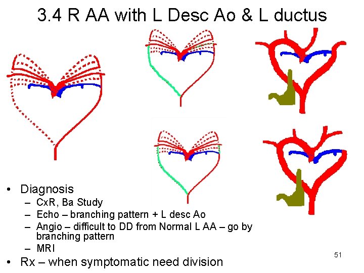 3. 4 R AA with L Desc Ao & L ductus • Diagnosis –