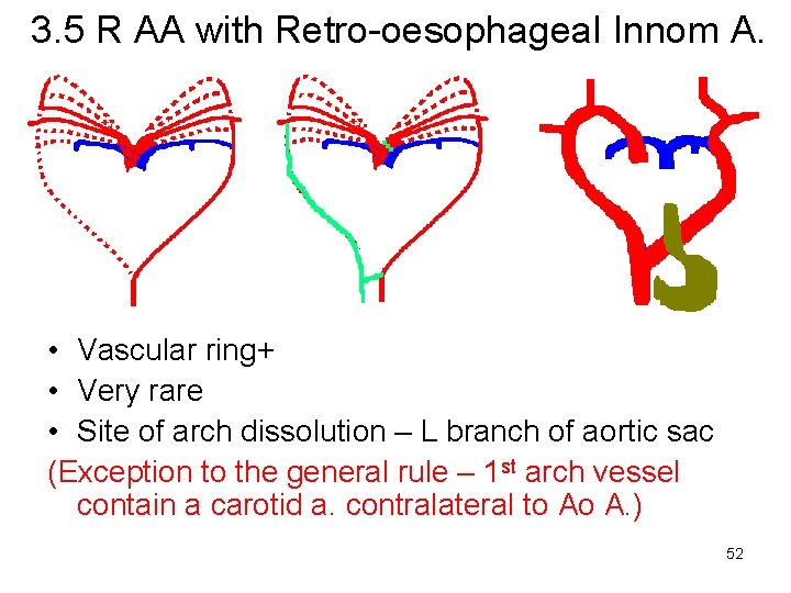 3. 5 R AA with Retro-oesophageal Innom A. • Vascular ring+ • Very rare
