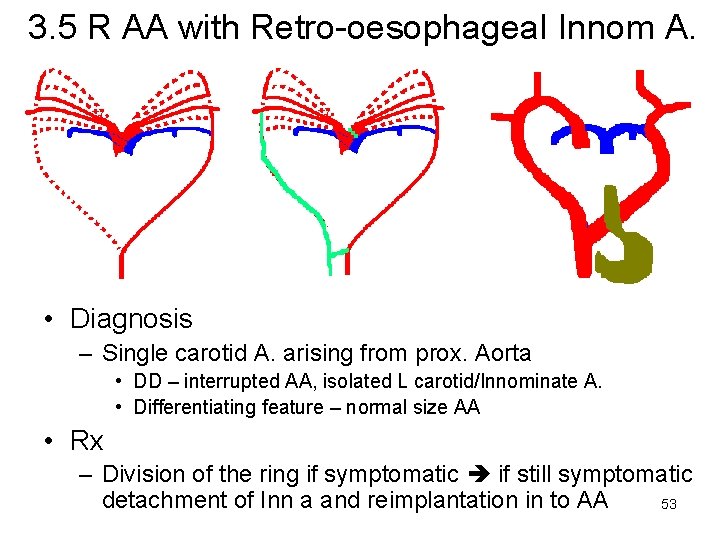 3. 5 R AA with Retro-oesophageal Innom A. • Diagnosis – Single carotid A.