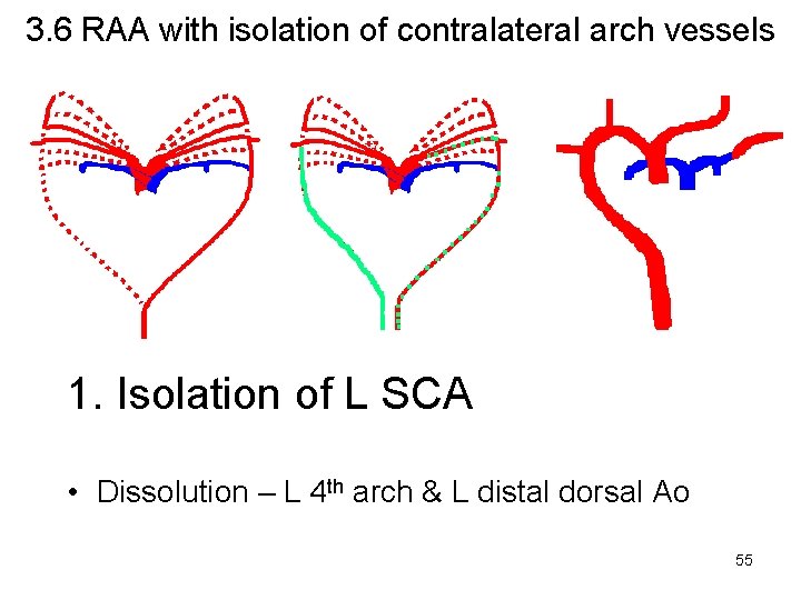 3. 6 RAA with isolation of contralateral arch vessels 1. Isolation of L SCA