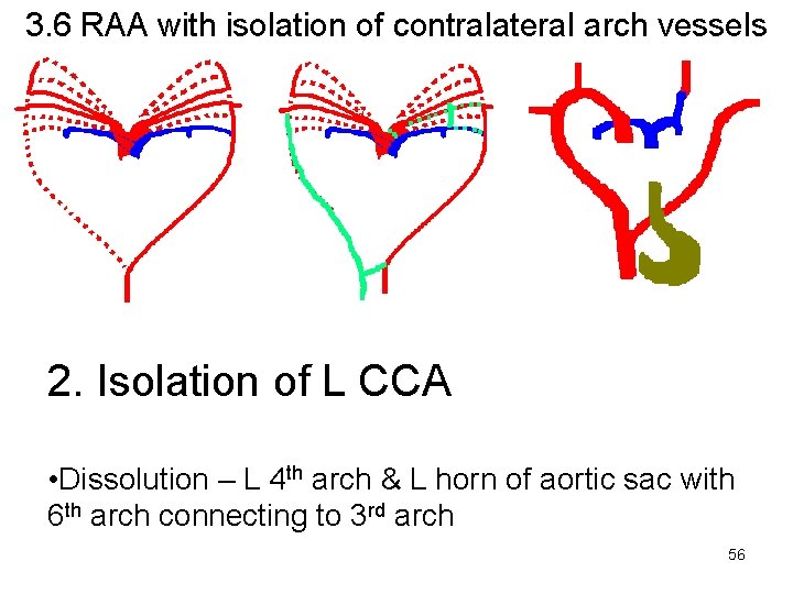 3. 6 RAA with isolation of contralateral arch vessels 2. Isolation of L CCA