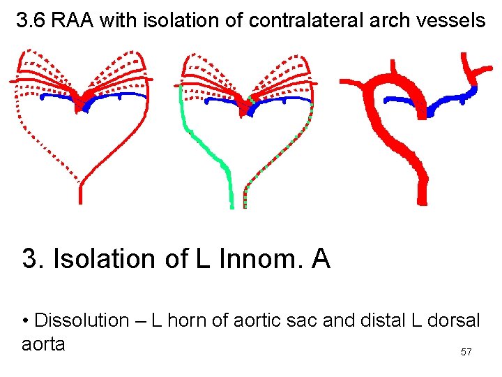 3. 6 RAA with isolation of contralateral arch vessels 3. Isolation of L Innom.