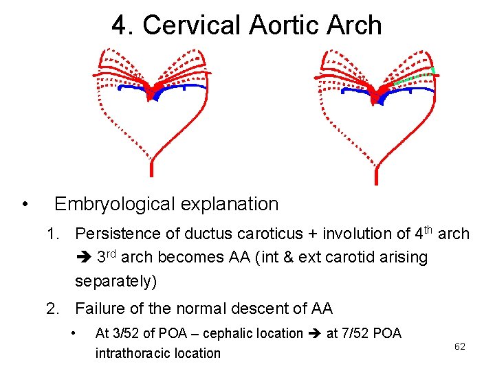 4. Cervical Aortic Arch • Embryological explanation 1. Persistence of ductus caroticus + involution