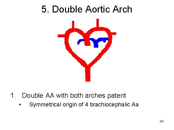 5. Double Aortic Arch 1. Double AA with both arches patent • Symmetrical origin