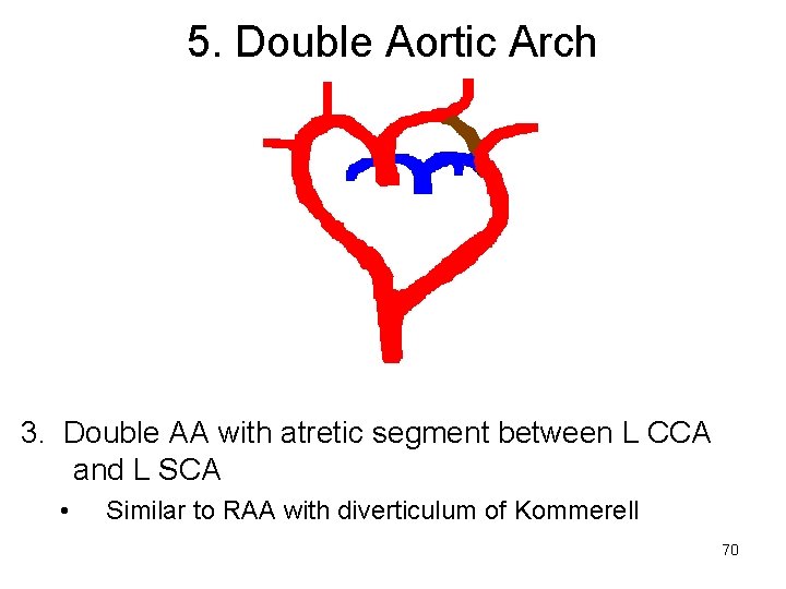 5. Double Aortic Arch 3. Double AA with atretic segment between L CCA and