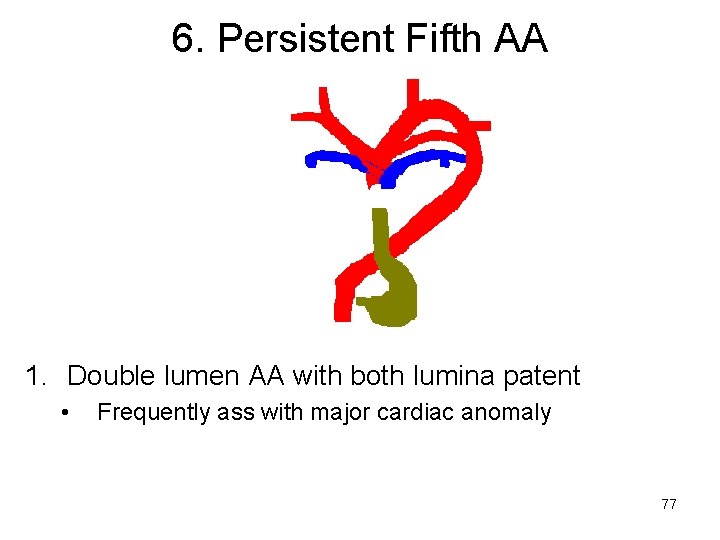 6. Persistent Fifth AA 1. Double lumen AA with both lumina patent • Frequently