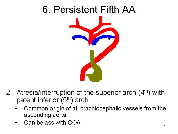 6. Persistent Fifth AA 2. Atresia/interruption of the superior arch (4 th) with patent