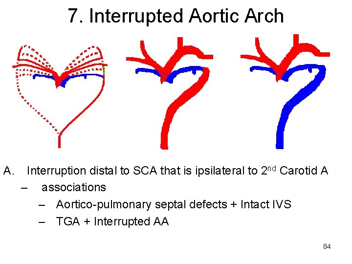 7. Interrupted Aortic Arch A. Interruption distal to SCA that is ipsilateral to 2