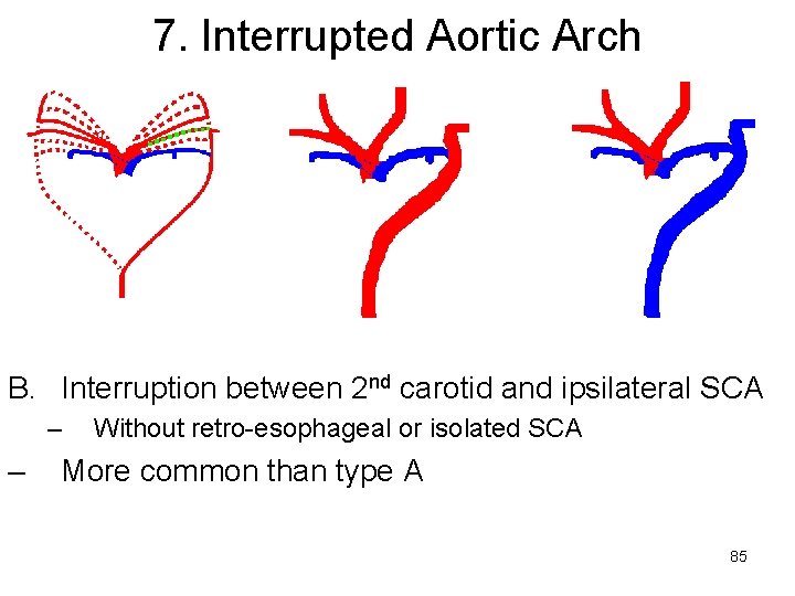 7. Interrupted Aortic Arch B. Interruption between 2 nd carotid and ipsilateral SCA –