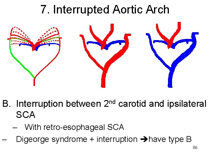 7. Interrupted Aortic Arch B. Interruption between 2 nd carotid and ipsilateral SCA –